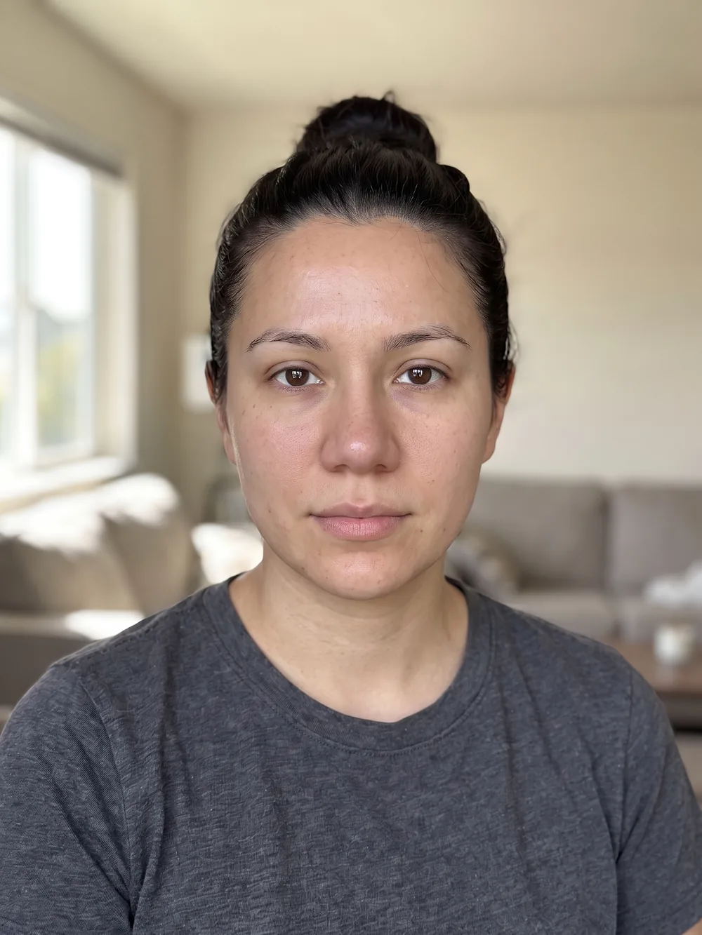 Bulbous nose tip rhinoplasty preview with a refined tip