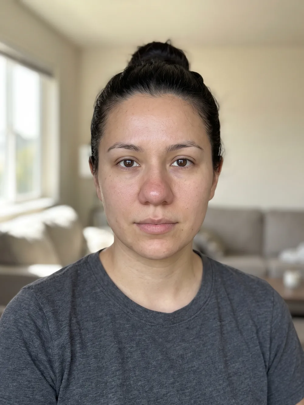 Bulbous nasal tip before rhinoplasty