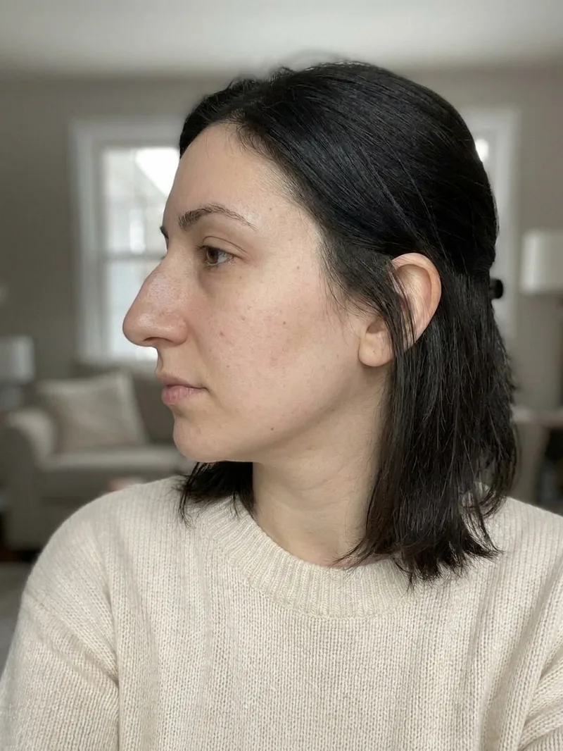 Rhinoplasty profile before