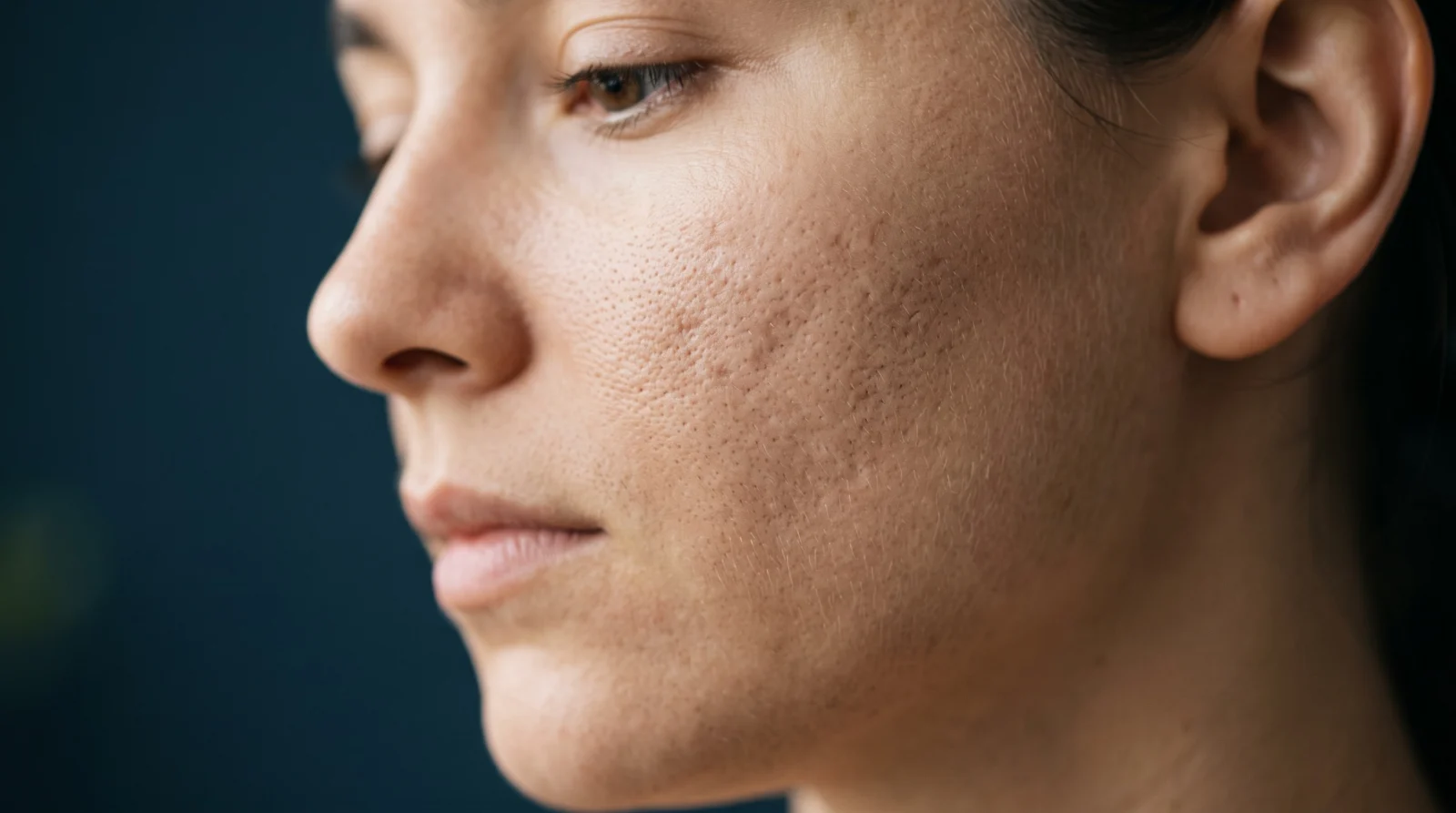 Macro close-up of a cheek showing shallow atrophic acne scarring and natural skin texture in soft daylight