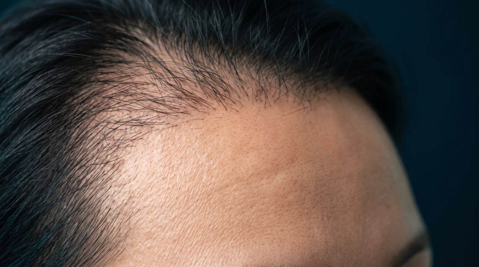 Close view of a man lifting his hair to inspect the frontal hairline
